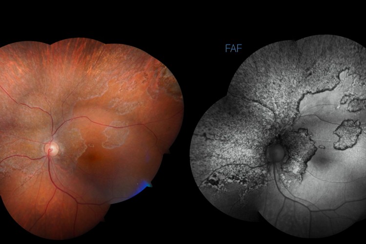 Si j’avais su - Un incident post-décollement de rétine