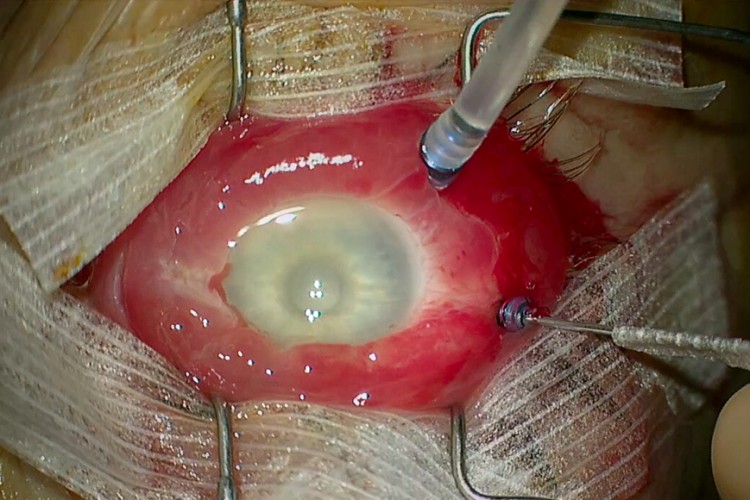 Endophtalmie avec endoscopie