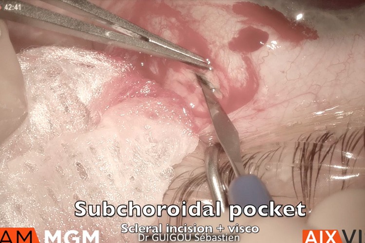 Ozurdex sous choroidien