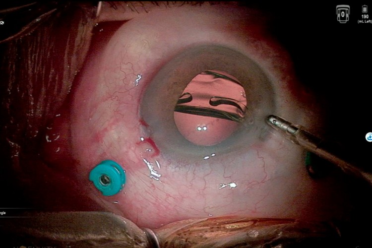 Real Surgery - Chirurgie combinée Cataracte et Membrane épirétinienne