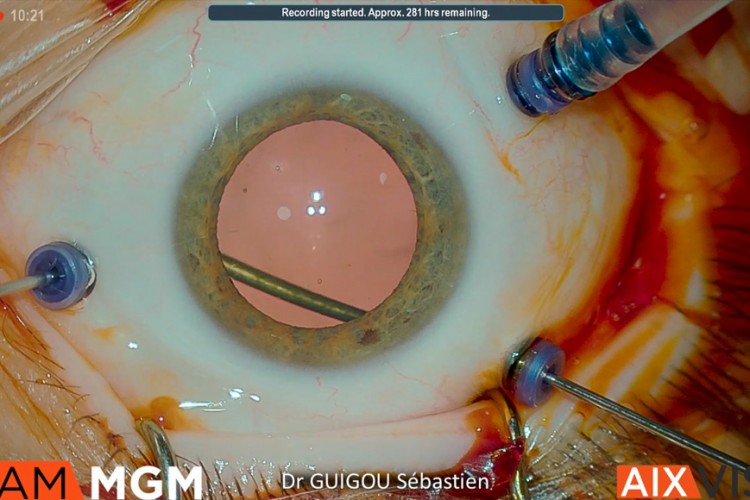 Prise en charge d'une rétinopathie diabétique proliférante compliquée d'hémorragies