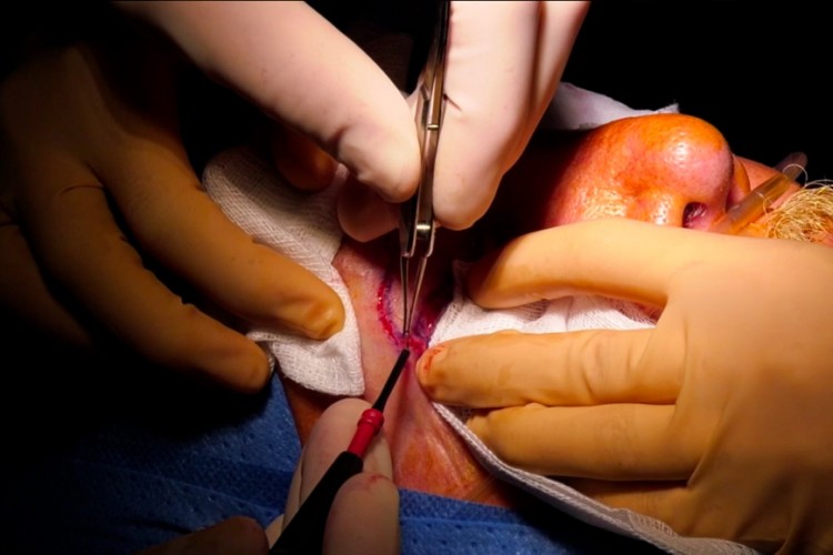 Real Surgery - Paupières