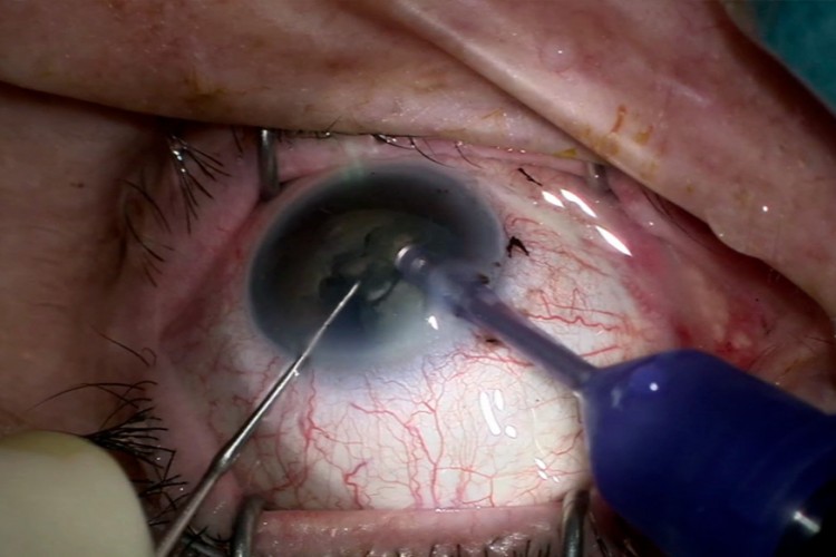Real Surgery - Cataracte + glaucome - Alcon Unity CS - Glaukos Stent