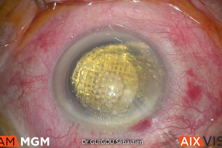 Cataracte femto laser