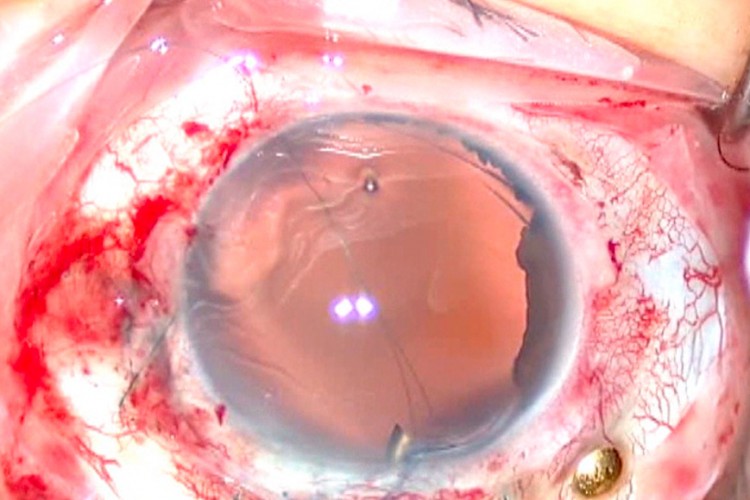 Aniridie aphaquie traumatisme, iol suture sclère Morcher