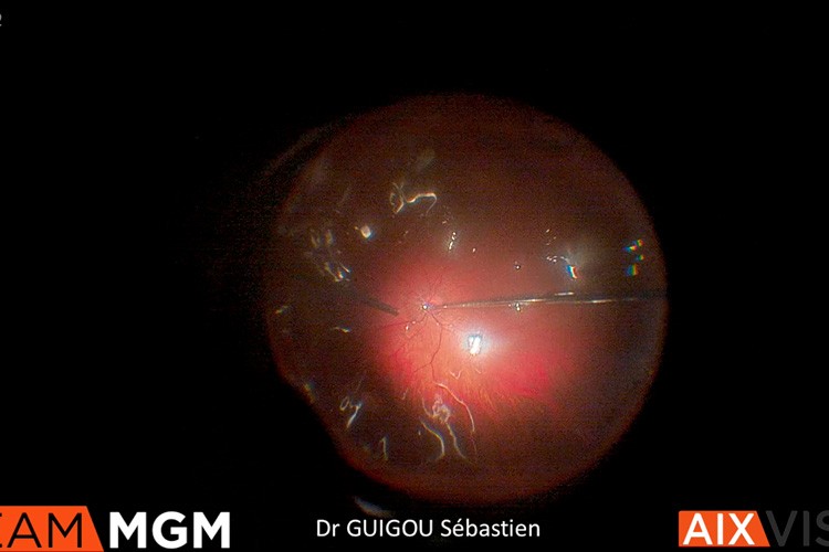 Wide field lens support Pr C Mateo