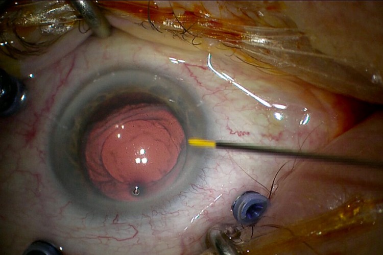 Ablation Iluvien luxé en chambre antérieure