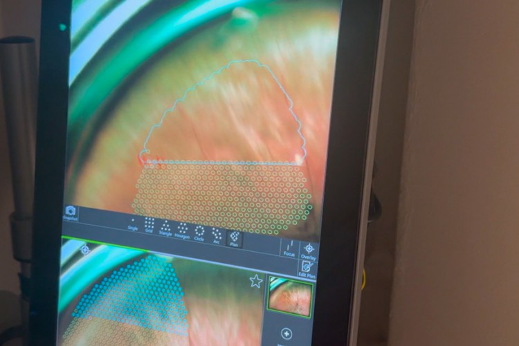 Réalisation d'une PPR avec le laser Navilas