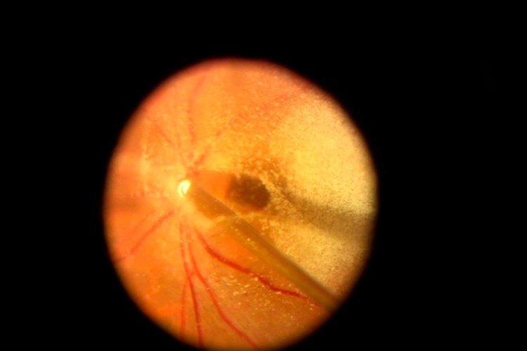 Real Surgery - Trou maculaire