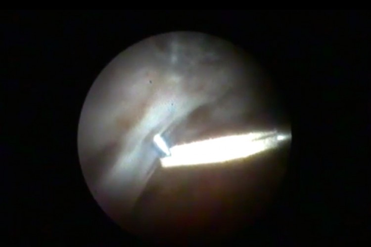 Décollement de rétine dissection PVR