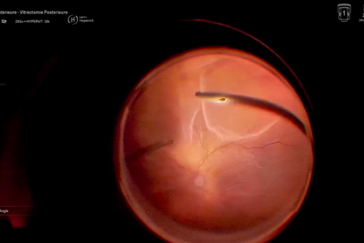 Real Surgery - Décollement de rétine