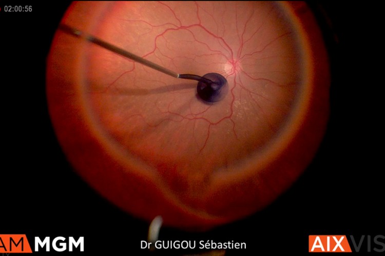 Trou maculaire réfractaire