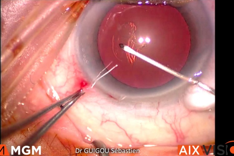 Cataracte bimanuelle