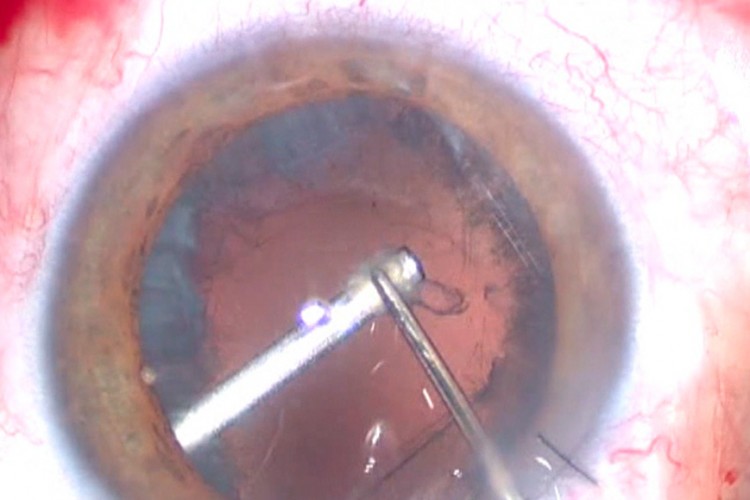 Cataracte compliquée rupture capsulaire vitrectomie IOL sulcus