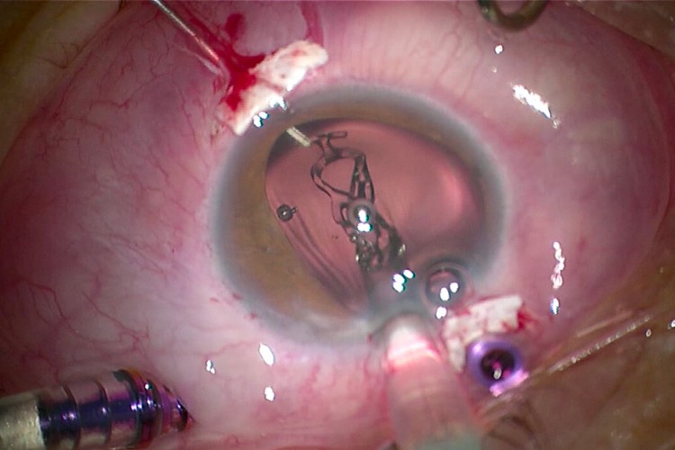 Carlevale 1.8mm en 27G le frisson