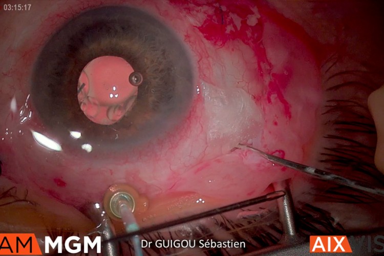 Décollement de rétine complexe membrane amniotique