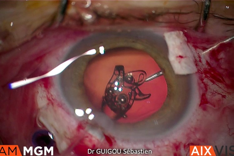 Luxation de noyau cristallinien Carlevale 27G