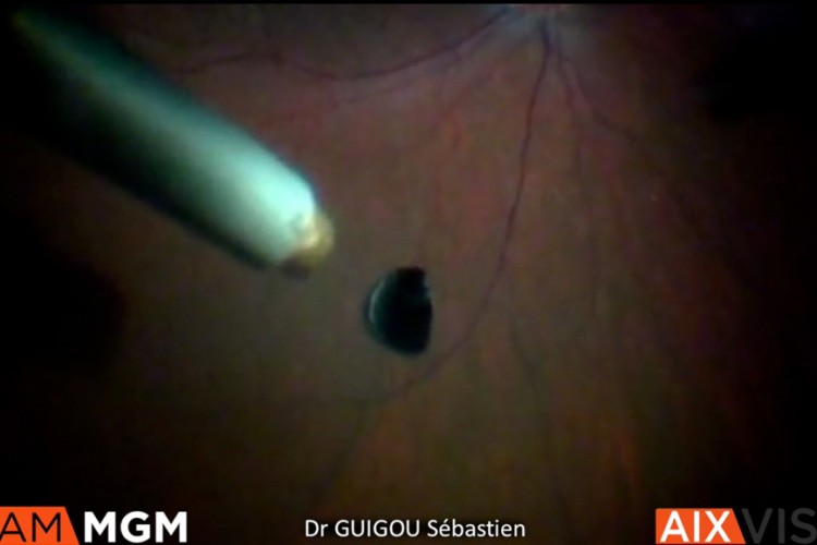 Ablation corps étranger intra oculaire à l'aimant 2