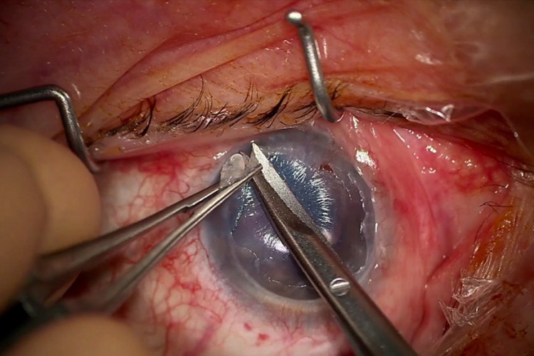 Real Surgery - Greffe EndoArt