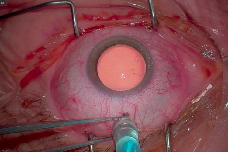 Real Surgery - Vitrectomie sur une rétinopathie diabétique proliférante compliquée d’une hémorragie