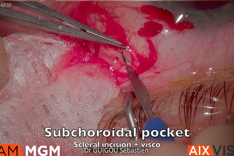 Ozurdex sous choroidien complet