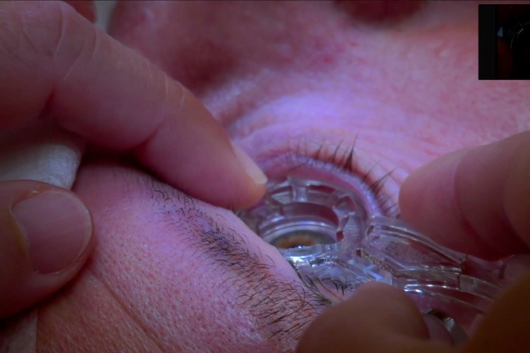 Real Surgery - Laser excimer