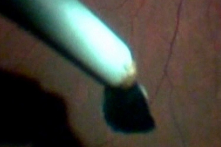 Ablation corps étranger intra oculaire à l'aimant