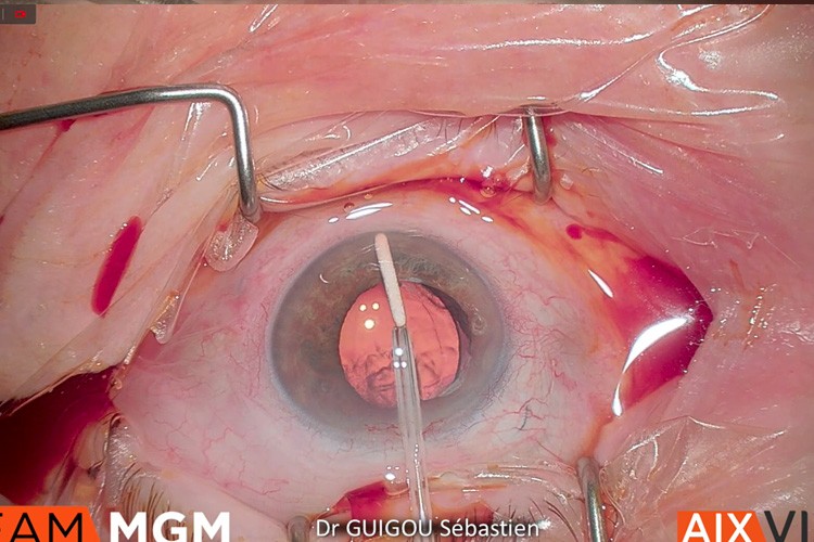 Ozurdex luxé en chambre antérieure ablation et injection suprachoroidienne