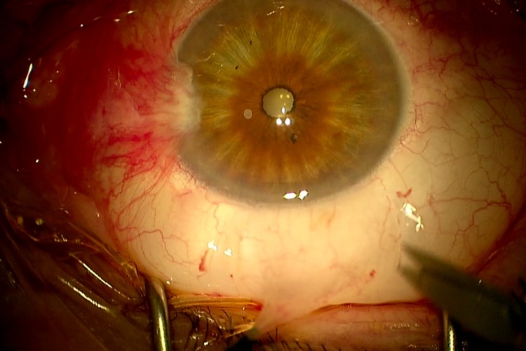 Real Surgery - Ptérygion