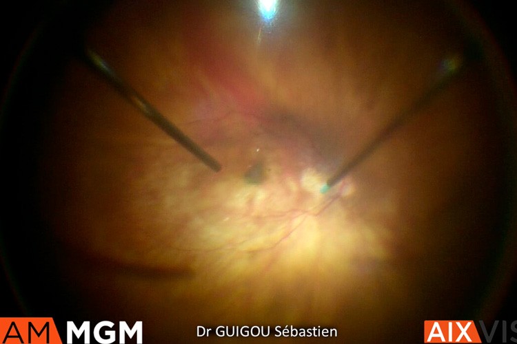 Trou maculaire membrane amniotique déshydratée parchemin pfcl