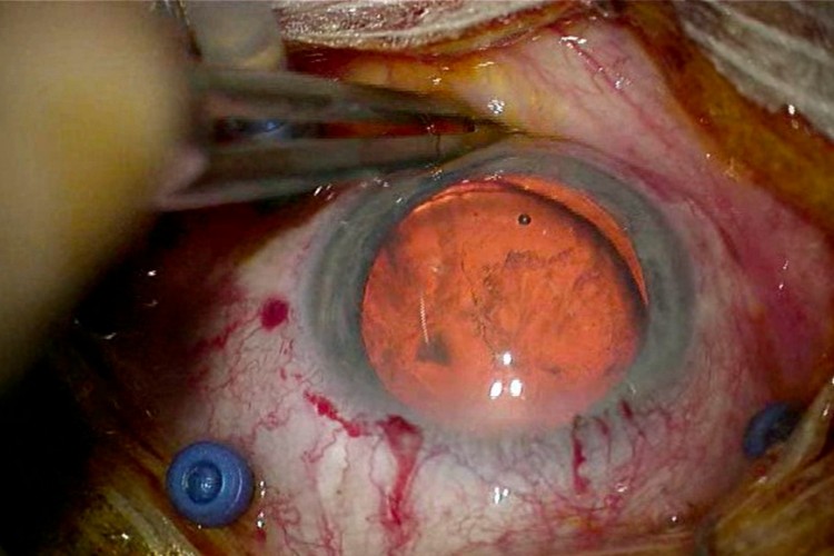 Cataracte traumatique iol clippé iris iridoplastie de Siepser