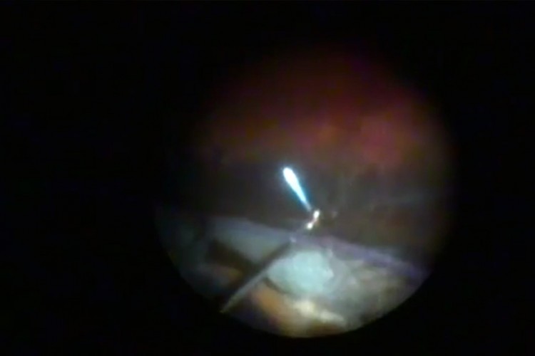 Exploration endoscopique IOL luxé