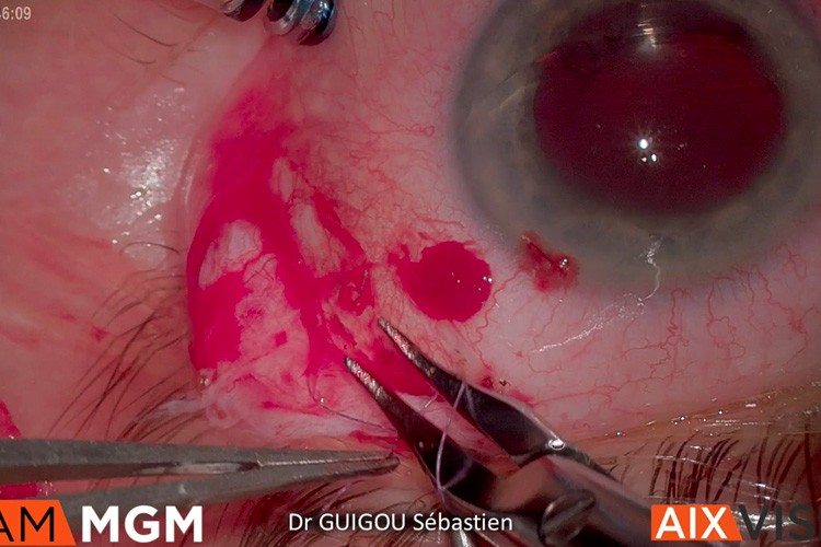 Ozurdex suprachoroidien syndrome Irvine Gass