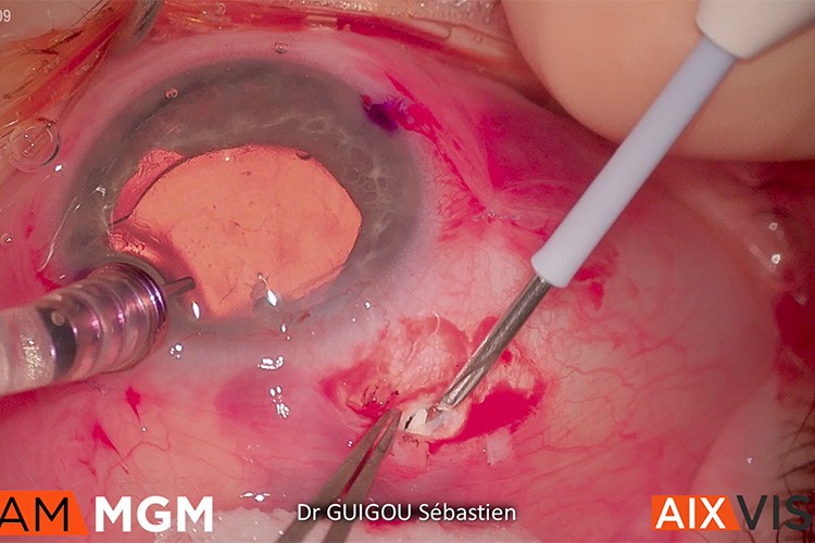 Ozurdex suprachoroidien VC