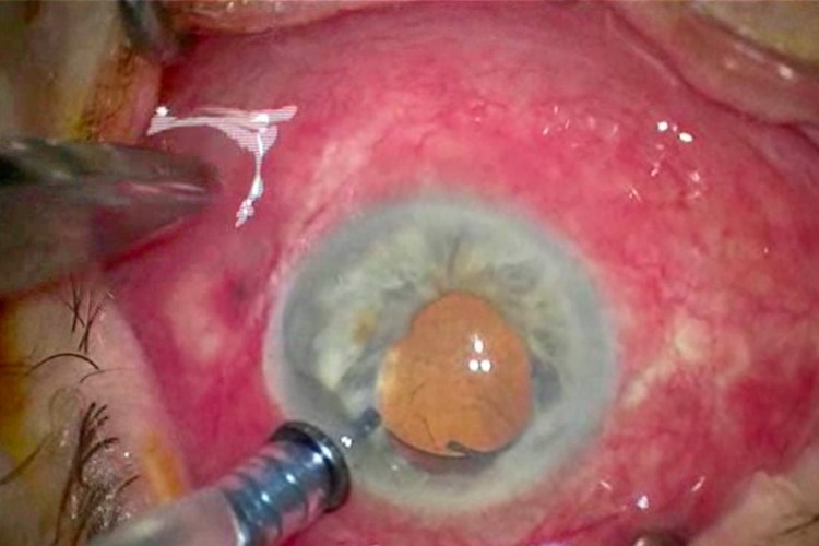 Explantation IOL Yamane nécrose