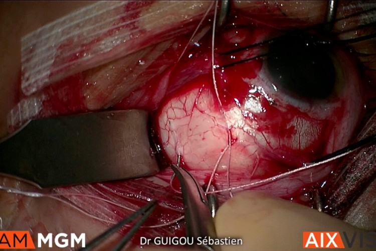 Décollement de rétine cryo indentation longitudinale