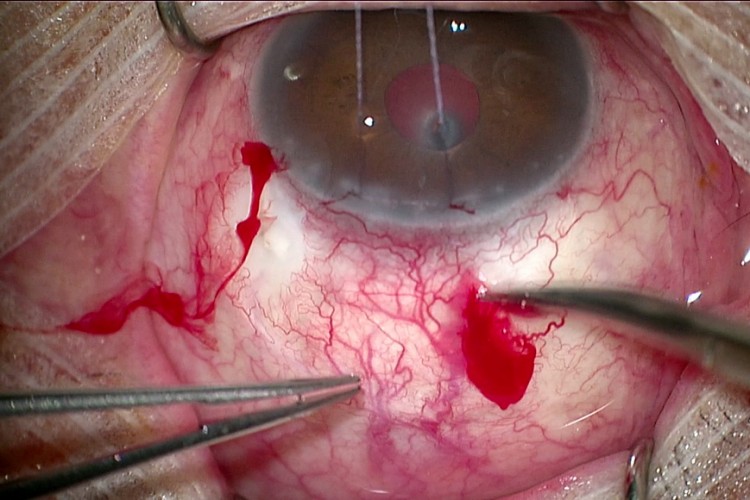 Real Surgery - Chirurgie filtrante Preserflo