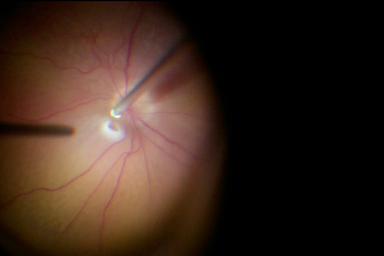 Décollement de rétine cryo rétinotomie