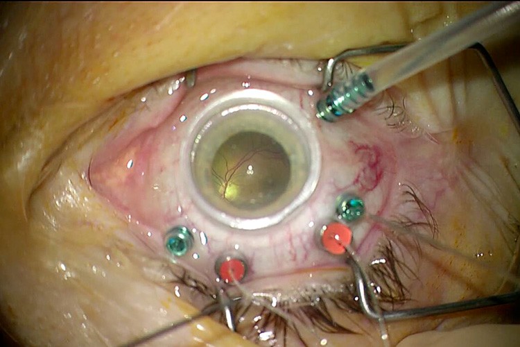 Trou maculaire membrane amniotique