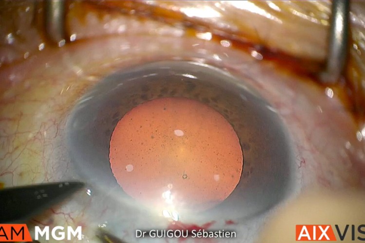 Chirurgie glaucome avec stent associée à une chirurgie de la cataracte