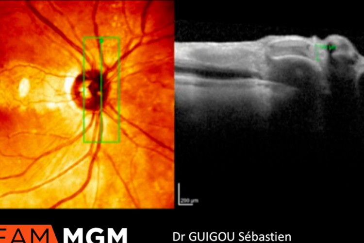 Prise en charge d'une occlusion artérielle rétinienne
