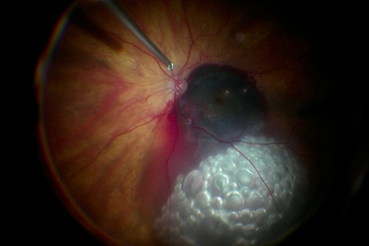 Hématome maculaire air actilyse