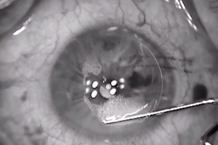 Real Surgery - Laser réfractif