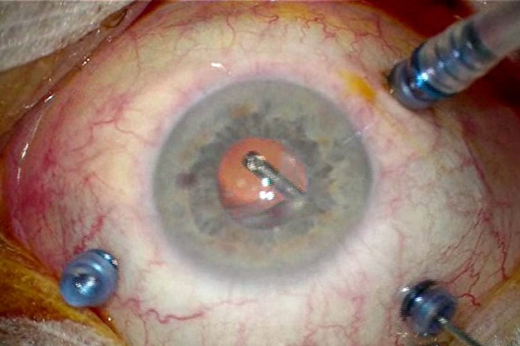 Explantation IOL Pac man 2