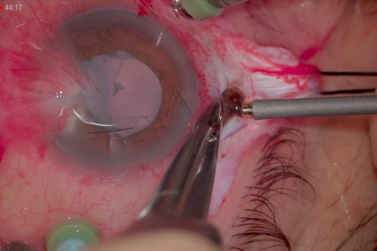 Ablation corps étranger intra oculaire vitrectomie endoscopie